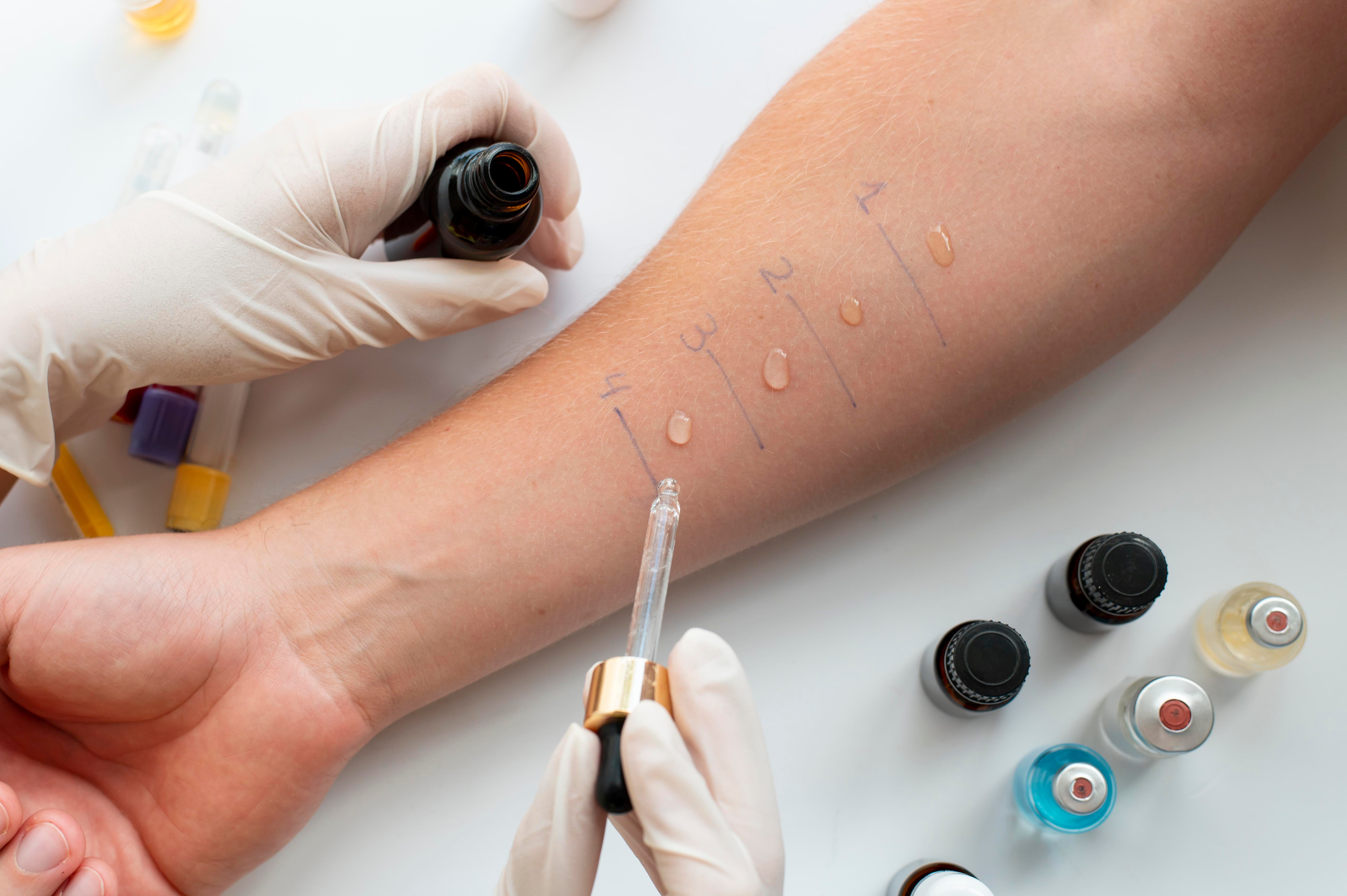 Allergy testing on a patient's arm